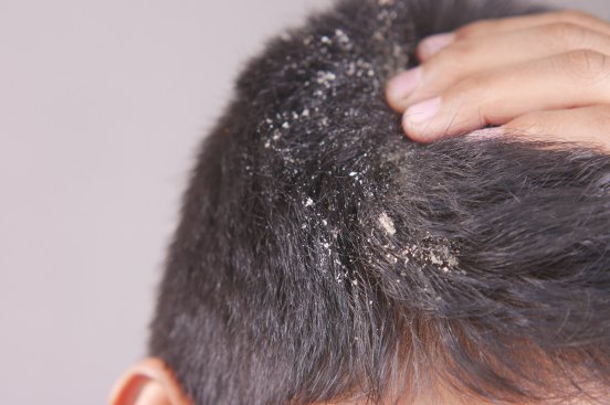 Alopecia - Dandruff - Natural Look Ayurvedic Clinic