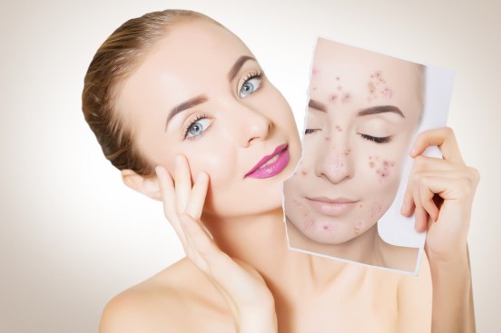 acne treatment - Natural Look Ayurvedic Clinic