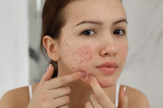 acne - Natural Look Ayurvedic Clinic