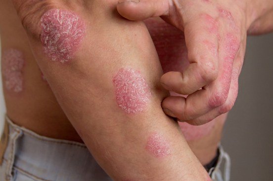 psoriasis - Natural Look Ayurvedic Clinic